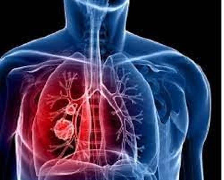 Abarwayi b'igituntu bariyongereye mu Rwanda ugereranyije n’imyaka ishize