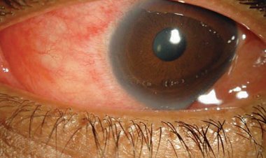 The Ministry of Health warns Rwandans against deadly eye disease