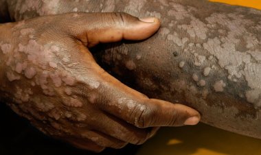 Abafite uburwayi bw’uruhu budakira bwa Psoriasis bagorwa no kubona imiti ituma butabazahaza
