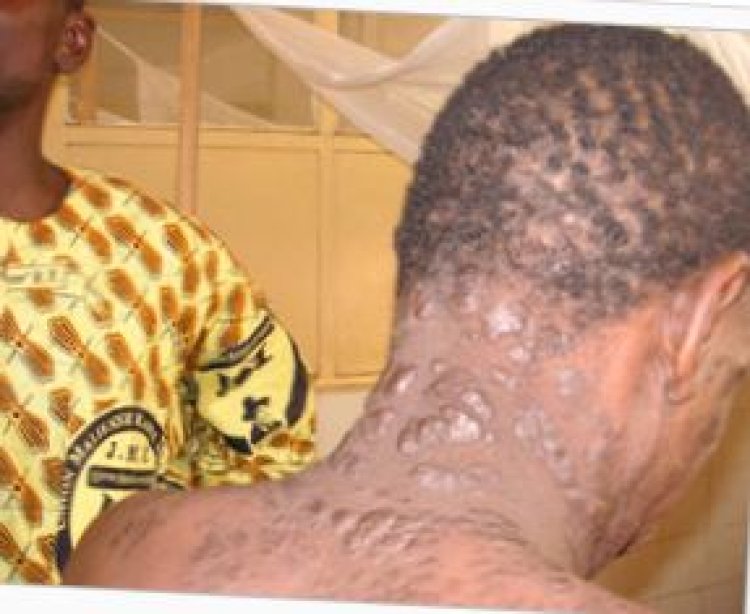 U Rwanda rwafashe ingamba zo kurwanya indwara y’ibibembe