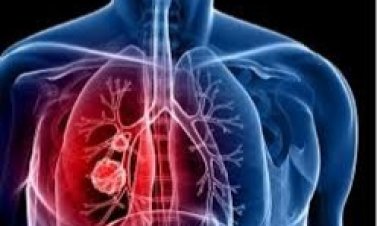 Abavuzi gakondo n’amavuriro mu rugamba rwo kurwanya igituntu