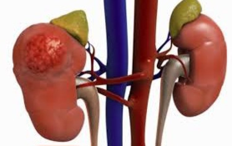 Kirehe: Barasaba gusobanurirwa uburwayi bw'impyiko